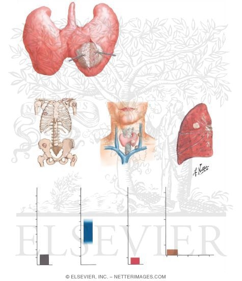 Hurthle Cell Thyroid Carcinoma