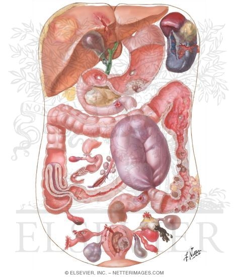 The Acute Abdomen