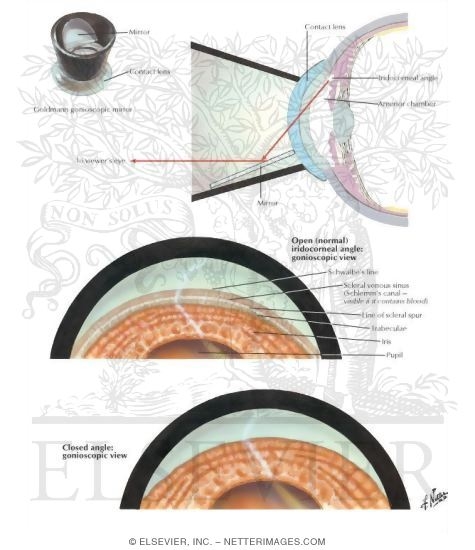 Gonioscopy Anterior Chamber Angle of Eye