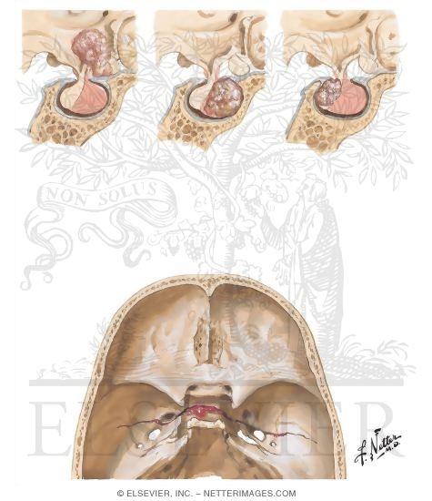 Nontumorous Lesions of the Pituitary Gland