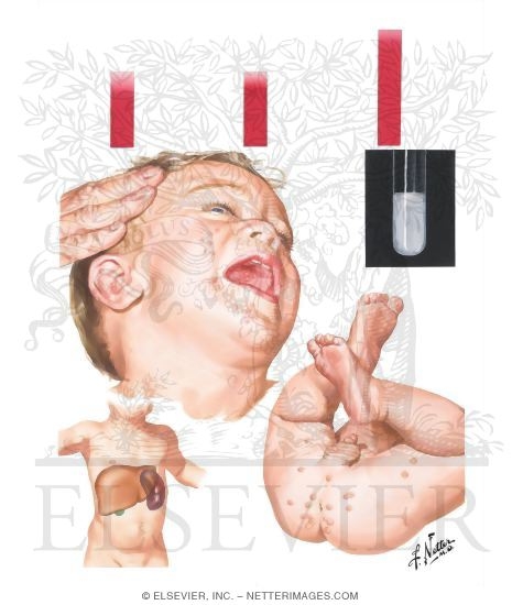 Clinical Manifestations of Hypertriglyceridemia