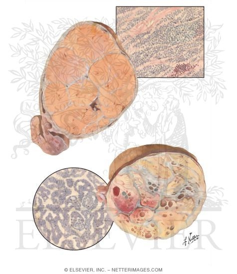 Testicular Tumors I - Seminoma, Embryonal Carcinoma