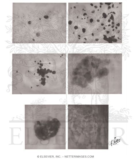 Microscopic Urine Examination - Abnormal Cells and Tissue in Urinary Sediment