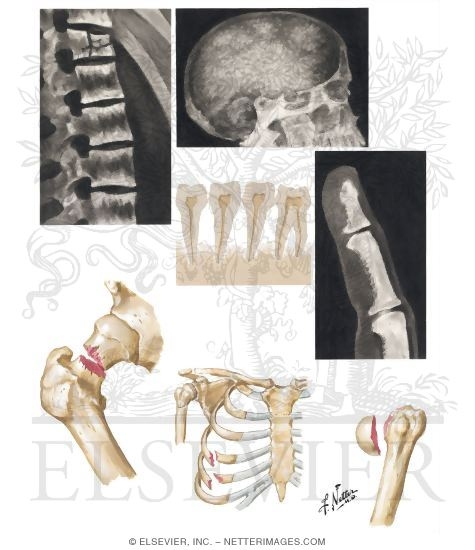 Bone Manifestations of Secondary Hyperparathyroidism In Chronic Renal Disease