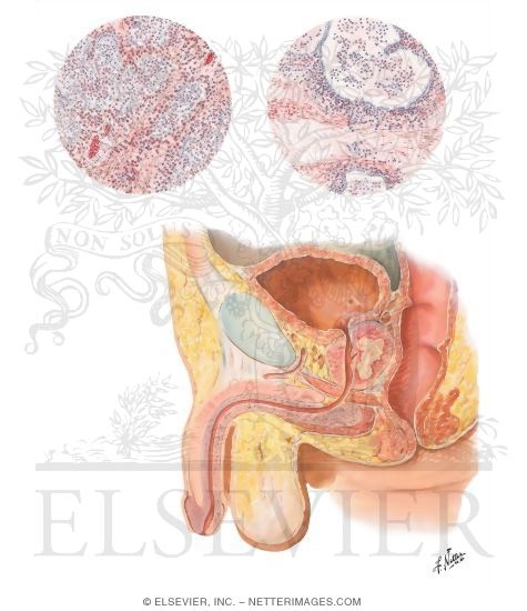 Prostatitis