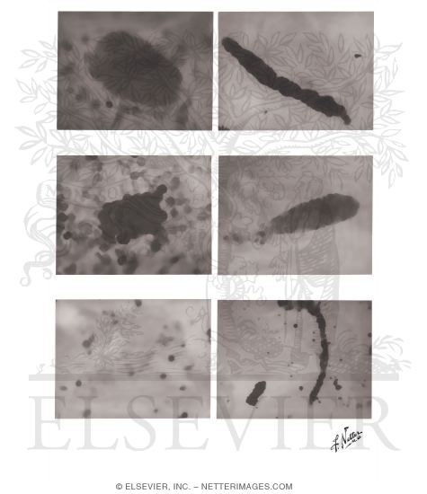 Microscopic Urine Examination - Stained Urinary Sediment Isolated on Millipore Filter