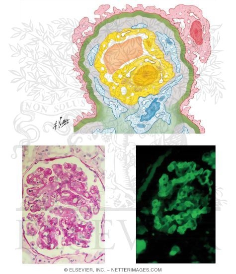 Hemolytic-Uremic Syndrome (Intravascular Coagulation and Thrombotic Microangiopathy)