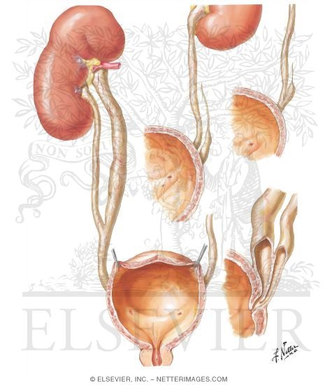 Incomplete Duplication of Ureter