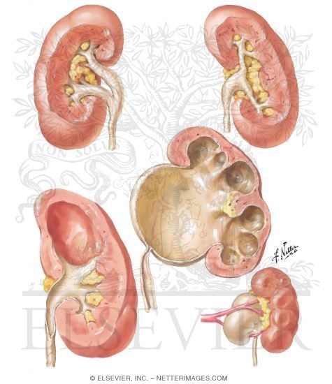 Anomalies of Renal Pelvis and Calyces