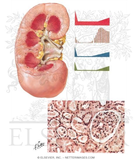 Acute Renal Failure