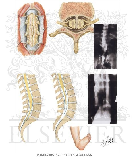 Spinal Dysraphism