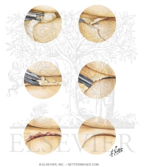 Meniscal Arthroscopic Surgery
