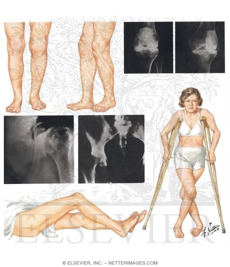 Knee, Shoulder, and Hip Joint Involvement in Rheumatoid Arthritis