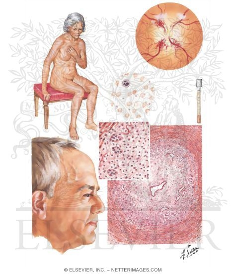 Giant-Cell (Temporal) Arteritis, Polymyalgia Rheumatica