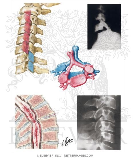 Fracture and Dislocation of Cervical Vertebrae