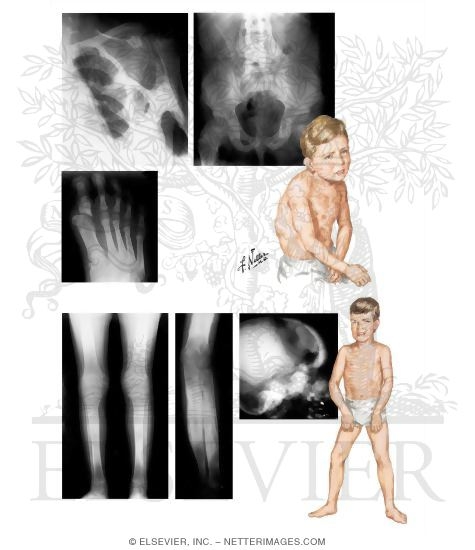 Myositis Ossificans Progressiva, Progressive Diaphyseal Dysplasia (Engelmann's Disease)