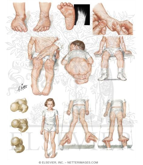 Rotational Deformities of Lower Limb: Toeing In