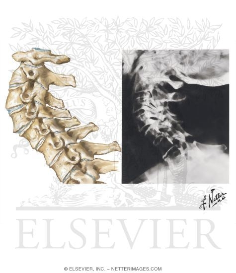 Spine Involvement in Osteoarthritis