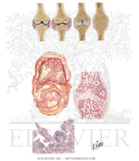 Joint Pathology in Rheumatoid Arthritis