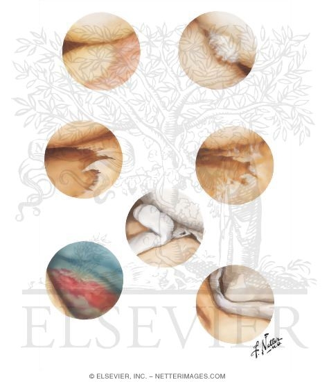 Tears of Meniscus