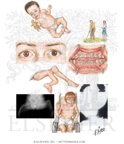 Osteogenesis Imperfecta