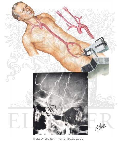 Femorocerebral Angiography