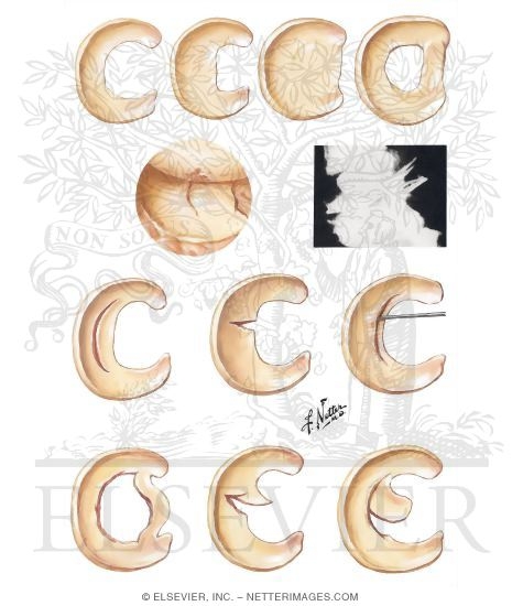 Congenital Meniscal Variations