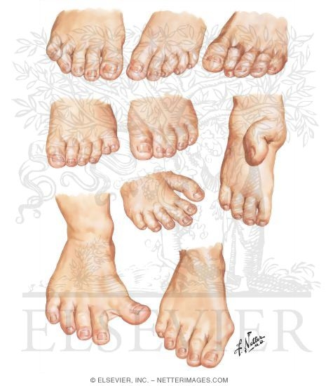 Congenital Toe Deformities