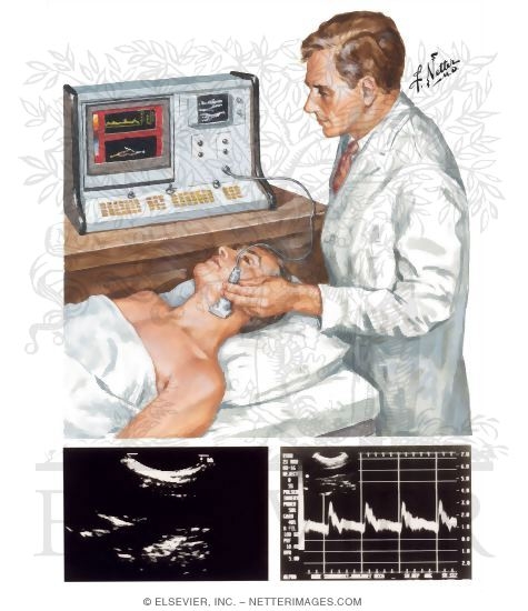 Noninvasive Tests for Carotid Artery Blood Flow