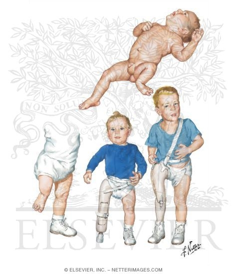 Illustration of Proximal Femoral Focal Deficiency from the Netter Collection