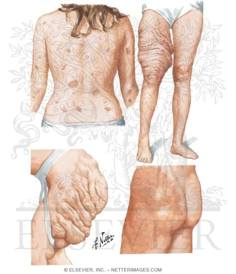 Cutaneous Lesions in Neurofibromatosis