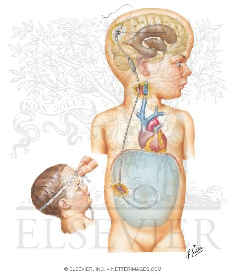 Hydrocephalus Shunt