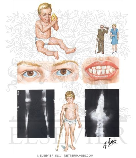 Osteogenesis Imperfecta