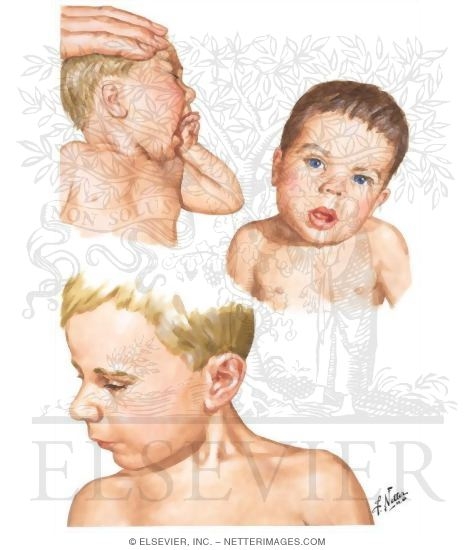 Congenital Muscular Torticollis (Wryneck)