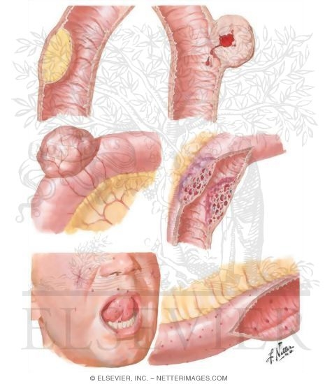 Benign Tumors of Small Intestine
