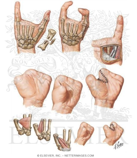 Additional Procedures to Improve Function