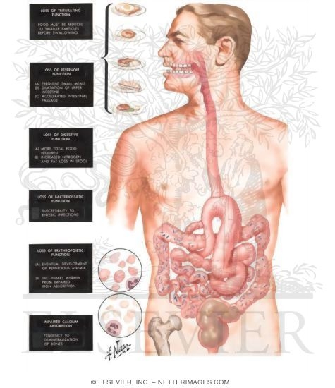 Effects of Total Gastrectomy
