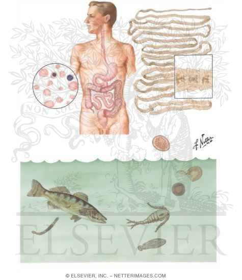 Parasitic Diseases IX - Diphyllobothriasis