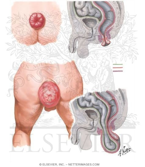 Proctologic Conditions II - Prolapse and Procidentia