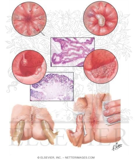 Proctologic Conditions III - Papillitis, Cryptitis, Adenomatous Polyps, Villous Tumor, Fissure and Pruritus Ani