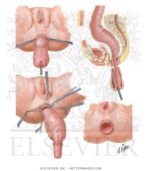 Congenital Megacolon