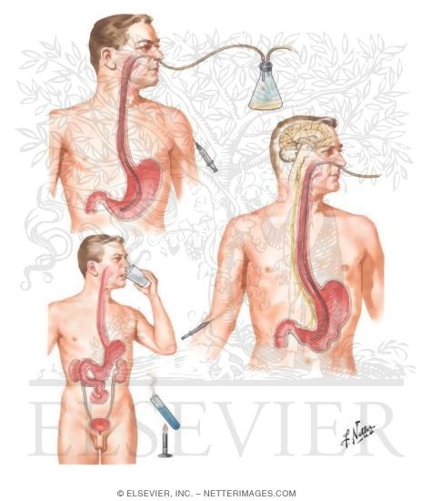Gastric Analysis