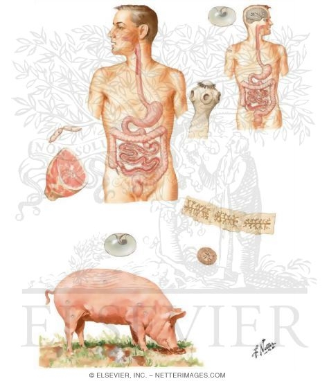 Parasitic Diseases VII - Taeniasis Solium (Cysticercosis Cellulosae)