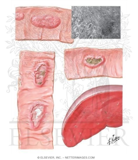 Pathology of Typhoid Fever