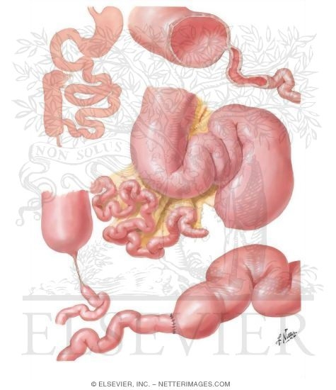 Pseudo obstruction intestinale chronique chez l adulte