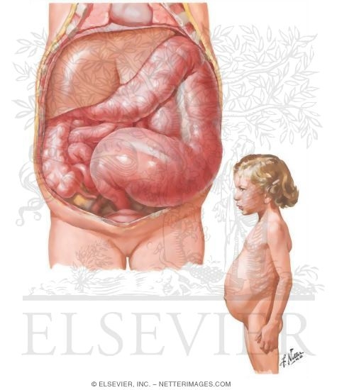 Congenital Intestinal Obstruction VI - Megacolon (Hirschsprung's Disease)