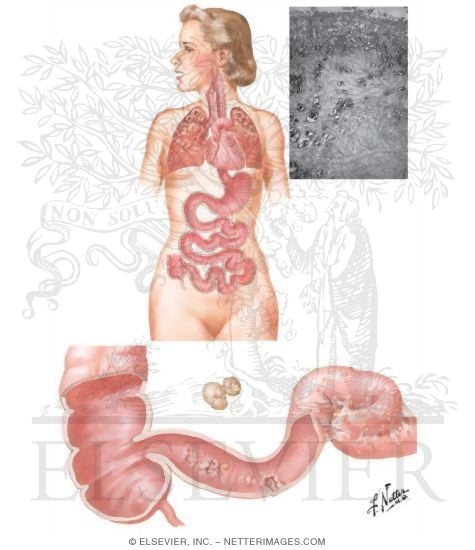 Intestinal Tuberculosis, Pathways of Infection, and Usual Location of Initial Lesion
