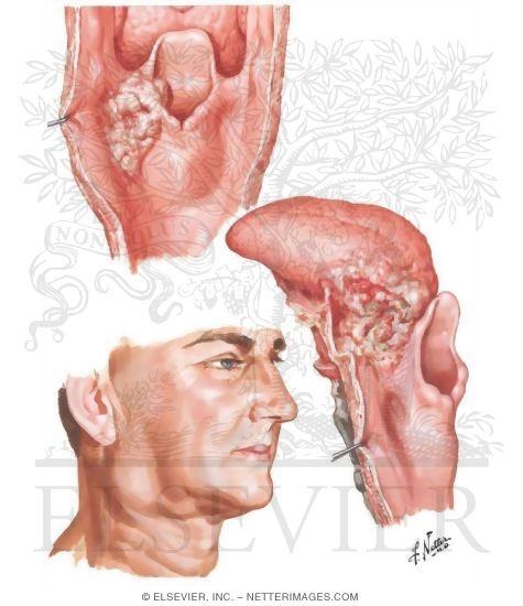 Malignant Tumors of Hypopharynx