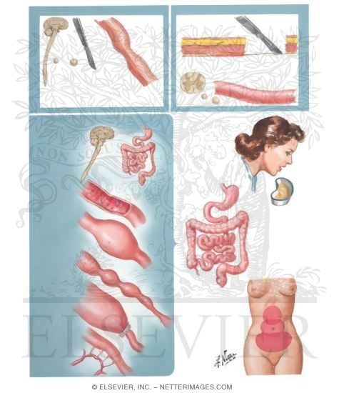 Pathophysiology of Small Intestine