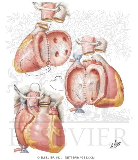 Heart Transplantation - Suture Method
